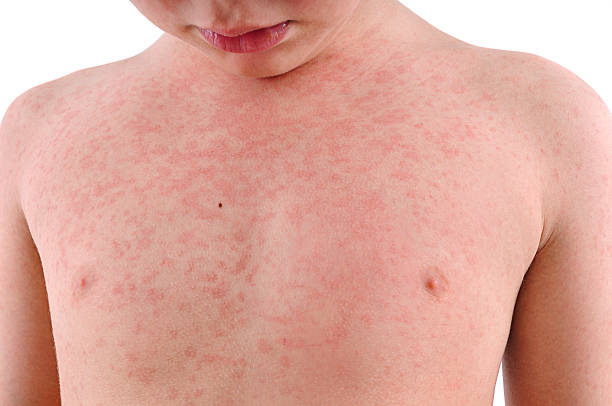 Child's Body Suffering Urticaria - Professional Health Forum