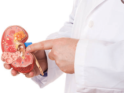 kidney stones - Professional Health Forum